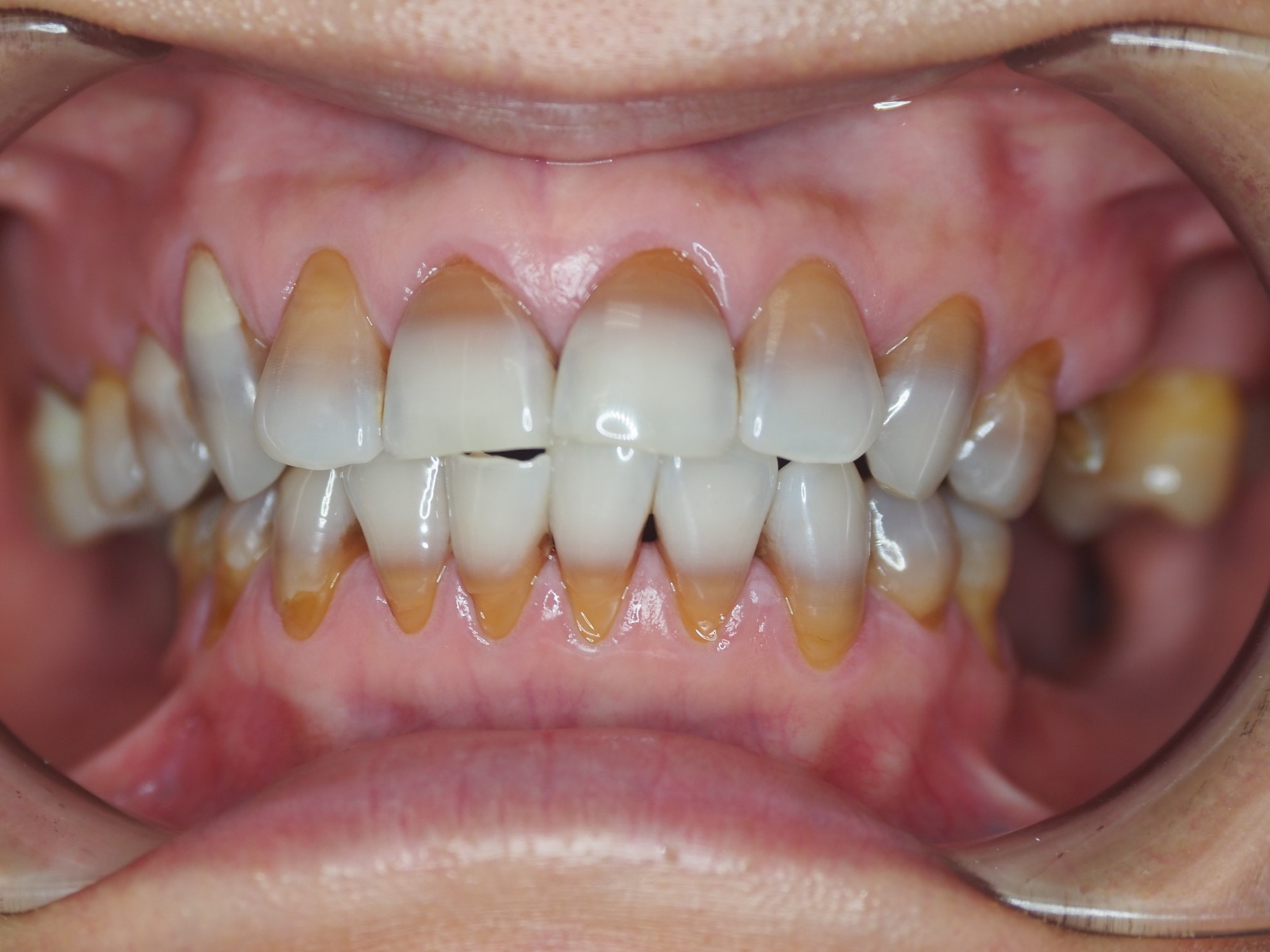 Before & After Pictures - THE FAVOUR DENTAL