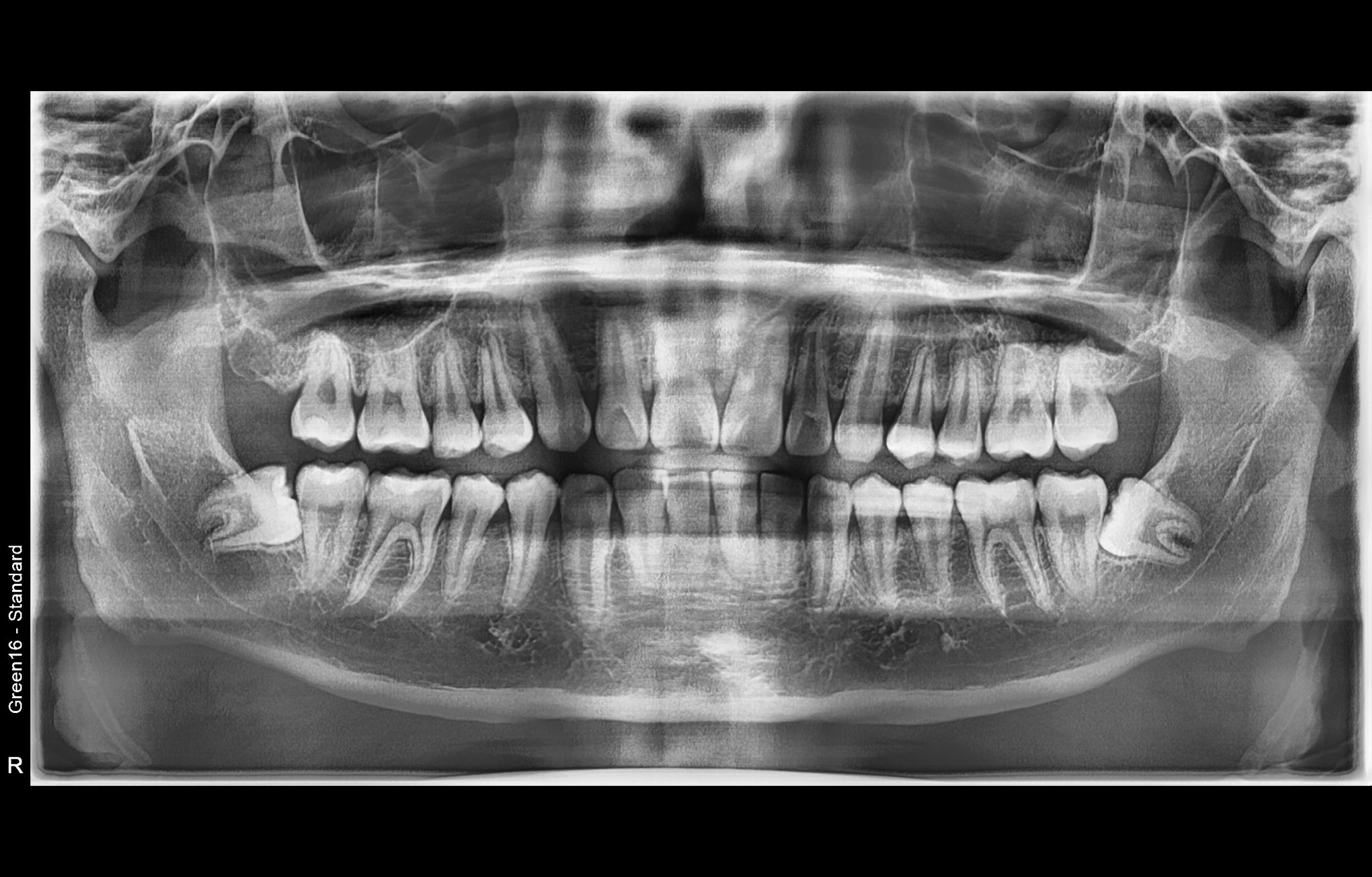 Wisdom Teeth Extraction Before & After Pictures THE FAVOUR DENTAL