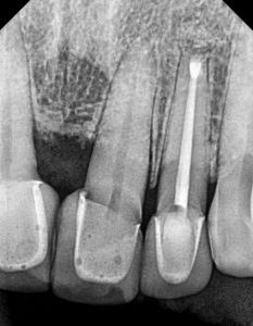 Picture of Root Canal Apicoectomy - Before & After Pictures - THE FAVOUR DENTAL - DEMO