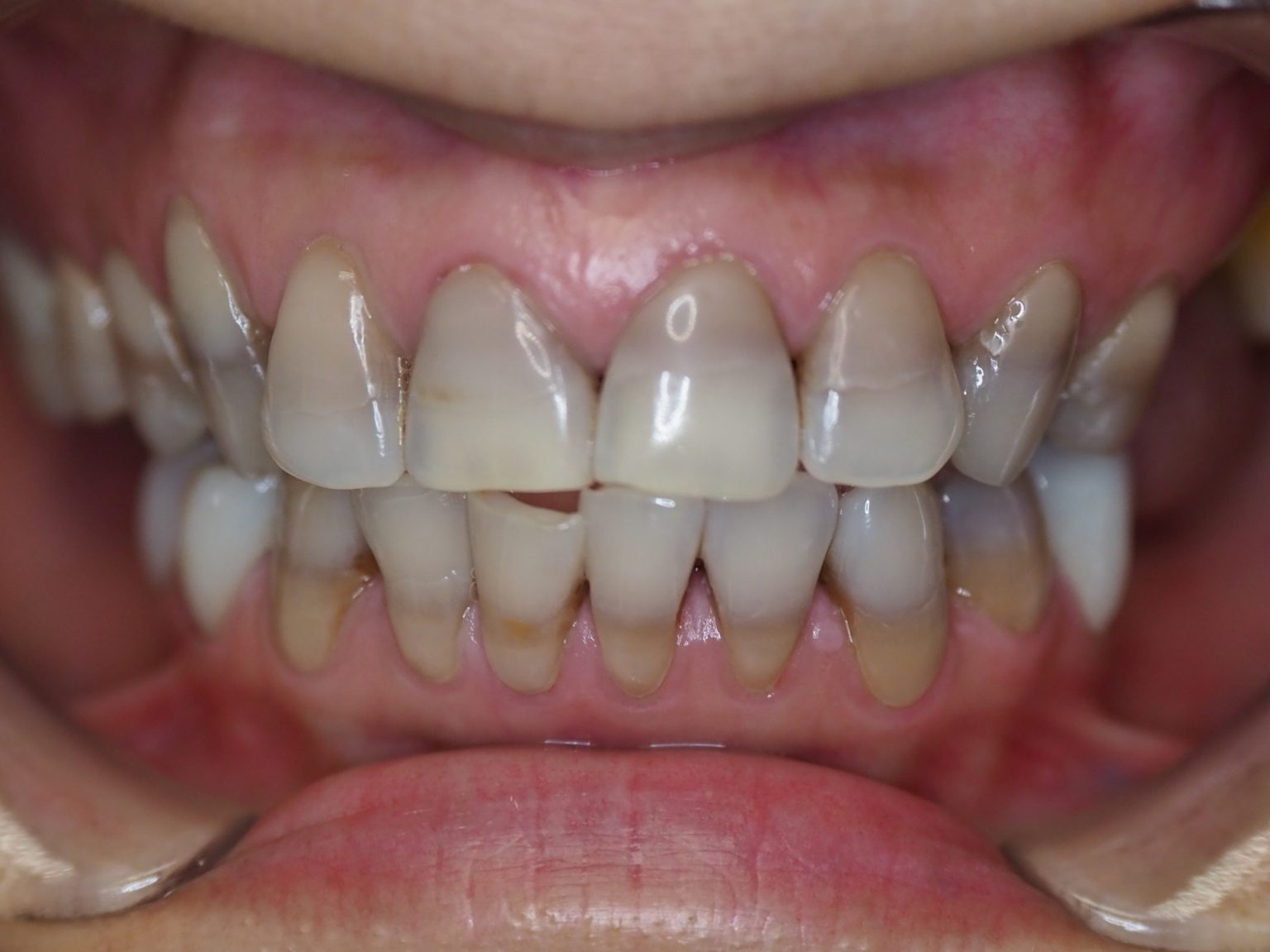 Composite Fillings Before & After Pictures The Favour Dental